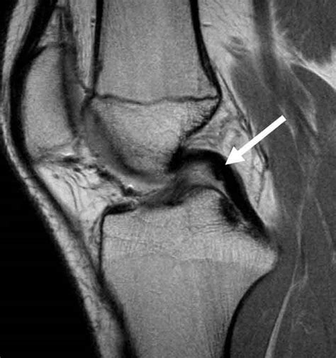 partial tear of pcl